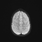 File:Bilateral mesial temporal polymicrogyria (Radiopaedia 76456-88181 Axial DWI 21).jpg