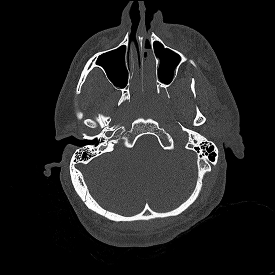 Bilateral occipital condyle fracture (type 2) (Radiopaedia 87675-104089 Axial bone thins 44).jpg