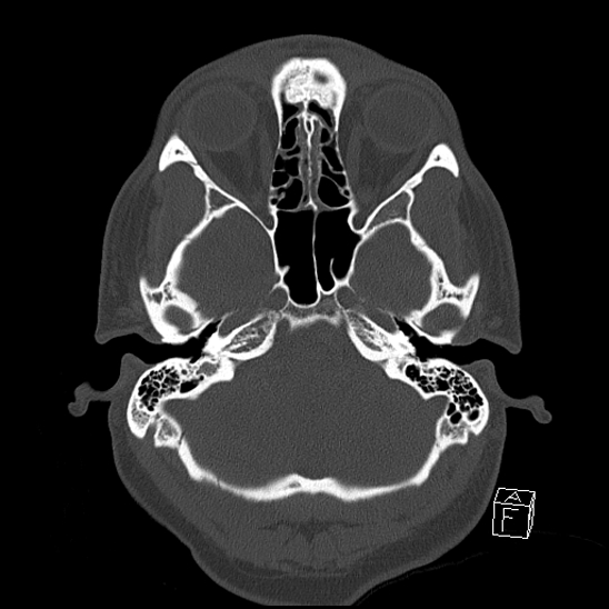 Bilateral occipital condyle fracture (type 2) (Radiopaedia 87675-104089 Axial bone window 26).jpg