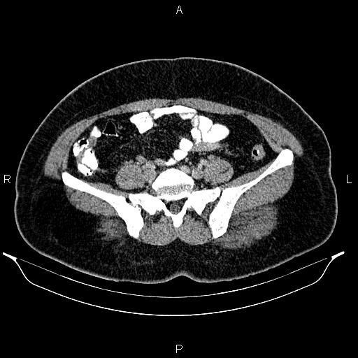 Bilateral ovarian dermoid cysts (Radiopaedia 85785-101603 A 76).jpg