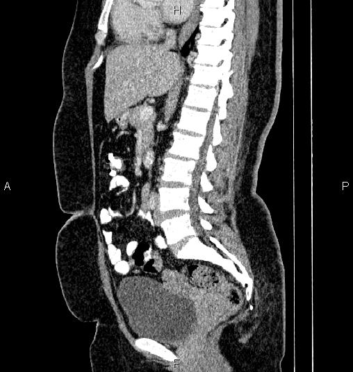 Bilateral ovarian dermoid cysts (Radiopaedia 85785-101603 D 44).jpg