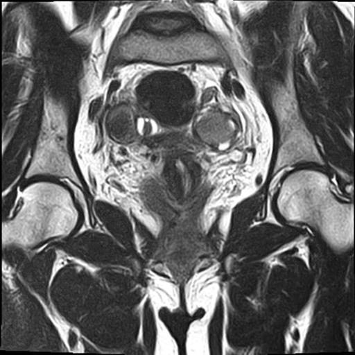 File:Bilateral ovarian endometriomas (Radiopaedia 87085-103347 Coronal T2 11).jpg
