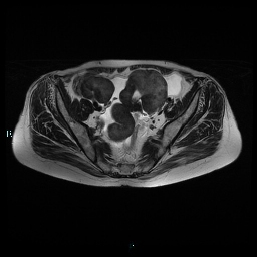 File:Bilateral ovarian fibroma (Radiopaedia 44568-48293 Axial T2 11).jpg