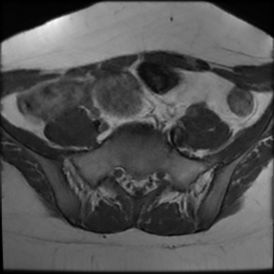 File:Bilateral ovarian fibrothecomas - adolescent (Radiopaedia 86604-102707 Axial T1 6).jpg