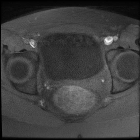 File:Bilateral ovarian fibrothecomas - adolescent (Radiopaedia 86604-102707 Axial T1 fat sat 21).jpg