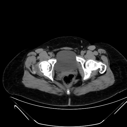 Bilateral ovarian mature cystic teratomas (Radiopaedia 79373-92457 Axial non-contrast 86).jpg