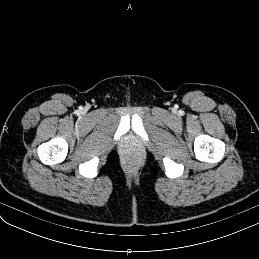 File:Bilateral ovarian teratoma (Radiopaedia 83131-97503 Axial With contrast 86).jpg