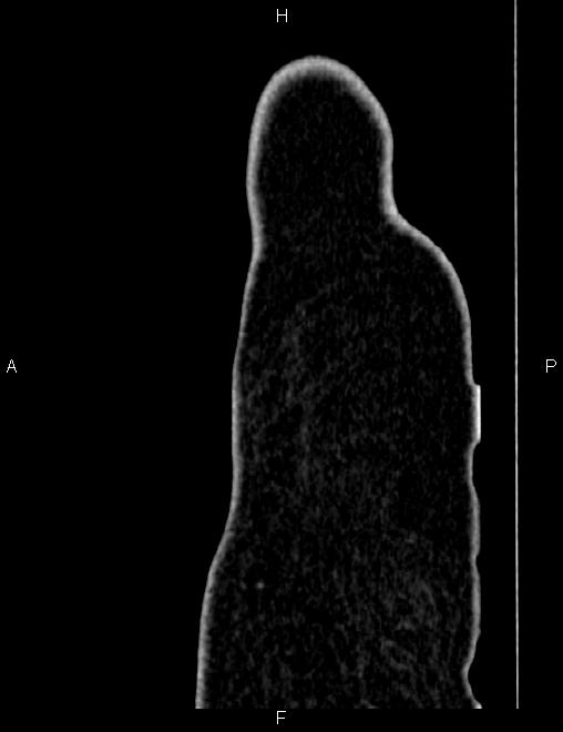 Bilateral ovarian teratoma (Radiopaedia 83131-97503 D 116).jpg