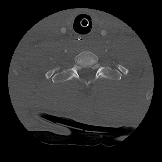 Bilateral perched facets with cord injury (Radiopaedia 45587-49713 Axial bone window 89).jpg