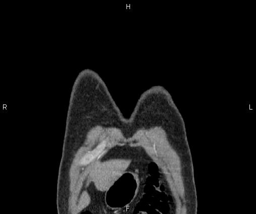 File:Bilateral pulmonary AVM (Radiopaedia 83134-97505 C 4).jpg