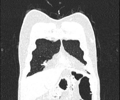 Bilateral pulmonary AVM (Radiopaedia 83134-97505 Coronal lung window 18).jpg