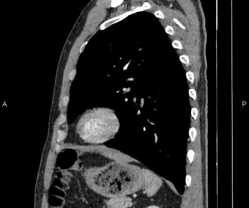 Bilateral pulmonary AVM (Radiopaedia 83134-97505 D 80).jpg