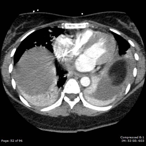 Bilateral pulmonary emboli with Hampton hump sign (Radiopaedia 54070-60246 Axial C+ CTPA 49).jpg