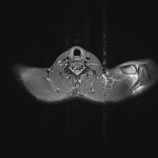 File:Bilateral spinoglenoid notch ganglion cysts (Radiopaedia 29577-30082 Axial STIR 11).jpg