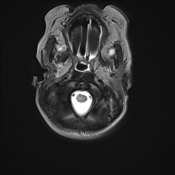 File:Bilateral subdural hemorrhage and parietal skull fracture (Radiopaedia 26058-26190 Axial T2 2).png