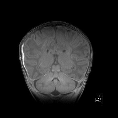 Bilateral subdural hemorrhage and parietal skull fracture (Radiopaedia 26058-26190 Coronal T1 35).png