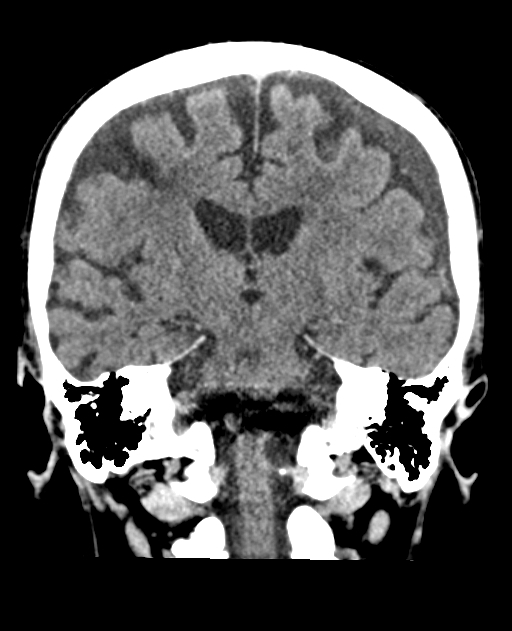 Bilateral subdural hygroma (Radiopaedia 73637-84421 Coronal non-contrast 28).jpg