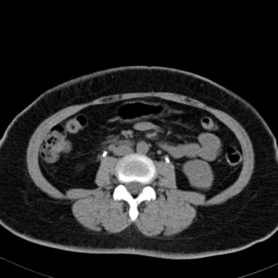 File:Bilateral ureteric stents (Radiopaedia 48795-53825 Axial non-contrast 31).jpg