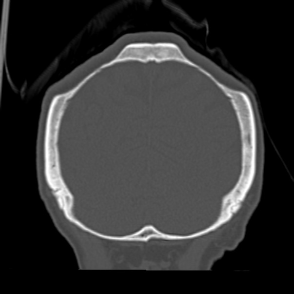 Biparietal osteodystrophy (Radiopaedia 46109-50463 Coronal bone window 88).jpg