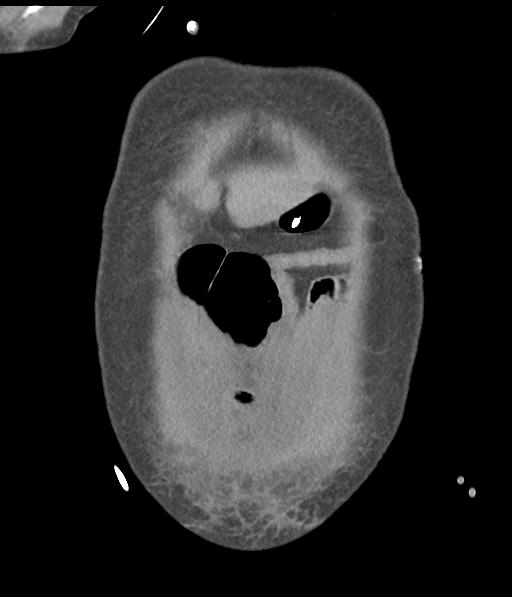 Bladder rupture post renal biopsy (Radiopaedia 30863-31572 Coronal non-contrast 10).jpg