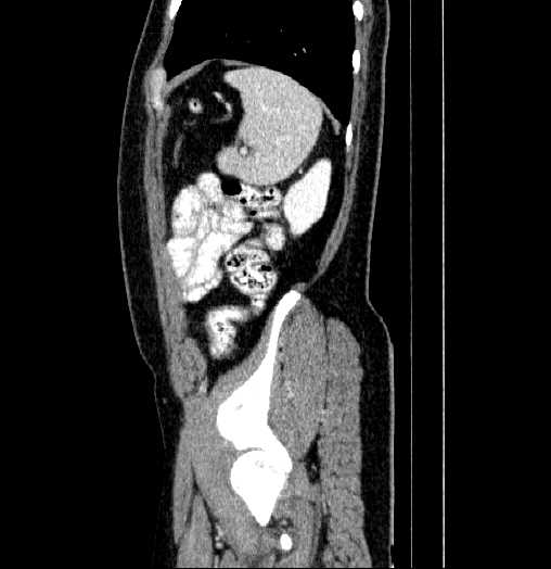 File:Blind-ending branch of a bifid ureter (Radiopaedia 61159-69048 B 72).jpg