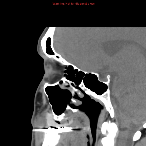 File:Blowout fracture with inferior rectus entrapment (Radiopaedia 12418-12673 C 16).jpg