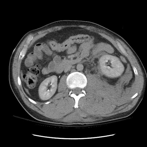 Blunt abdominal trauma with solid organ and musculoskelatal injury with active extravasation (Radiopaedia 68364-77895 Axial C+ delayed 61).jpg