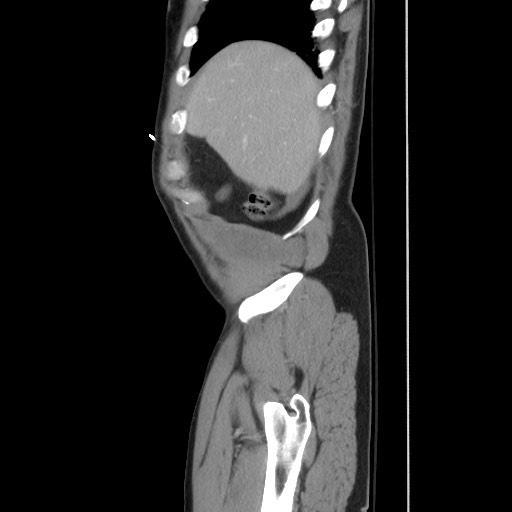 Blunt abdominal trauma with solid organ and musculoskelatal injury with active extravasation (Radiopaedia 68364-77895 C 30).jpg