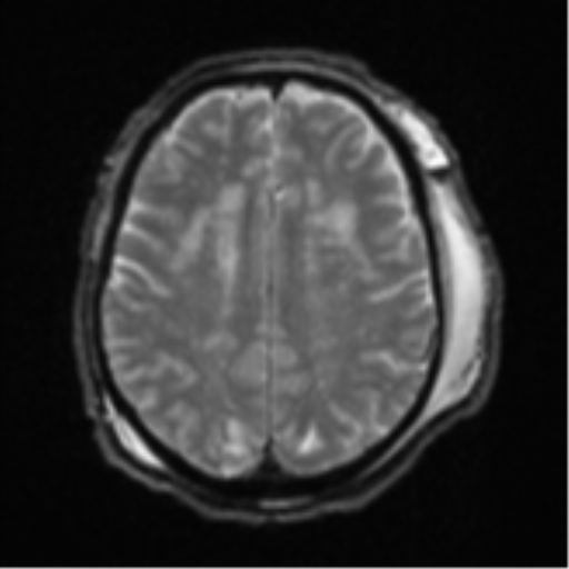 Blunt cerebrovascular injury (Radiopaedia 53682-59745 Axial DWI 21).png