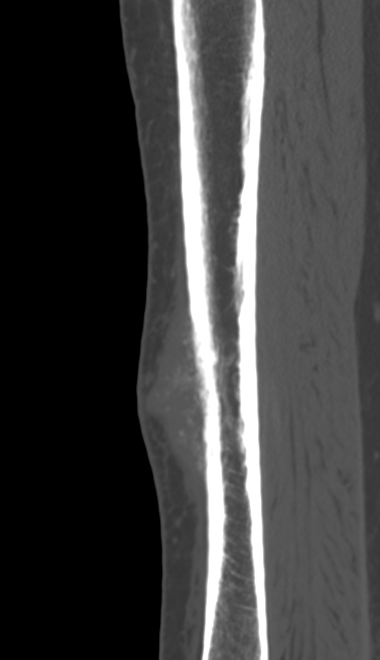 Bone metastasis - tibia (Radiopaedia 57665-64609 Sagittal bone window 68).jpg