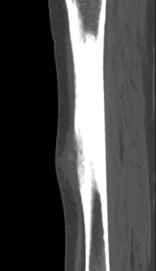 Bone metastasis - tibia (Radiopaedia 57665-64609 Sagittal bone window 99).jpg