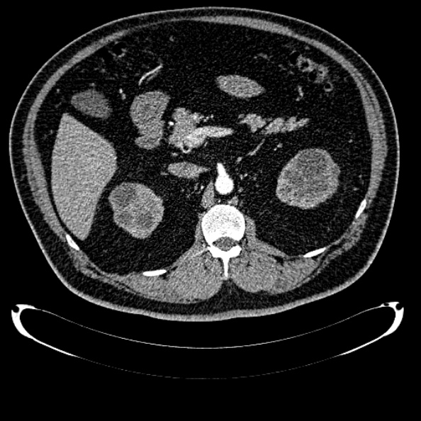 Bosniak renal cyst - type IV (Radiopaedia 24244-24518 B 116).jpg