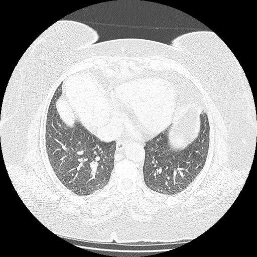 Bovine aortic arch - right internal mammary vein drains into the superior vena cava (Radiopaedia 63296-71875 Axial lung window 115).jpg