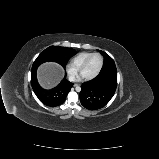 Bowel and splenic infarcts in acute lymphocytic leukemia (Radiopaedia 61055-68915 A 13).jpg