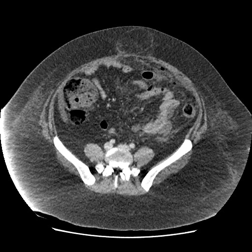 Bowel and splenic infarcts in acute lymphocytic leukemia (Radiopaedia 61055-68915 A 91).jpg