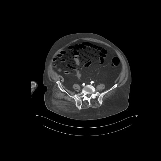 File:Bowel ischemia secondary to SMA occlusion with extensive portomesenteric venous gas (Radiopaedia 54656-60871 A 17).jpg
