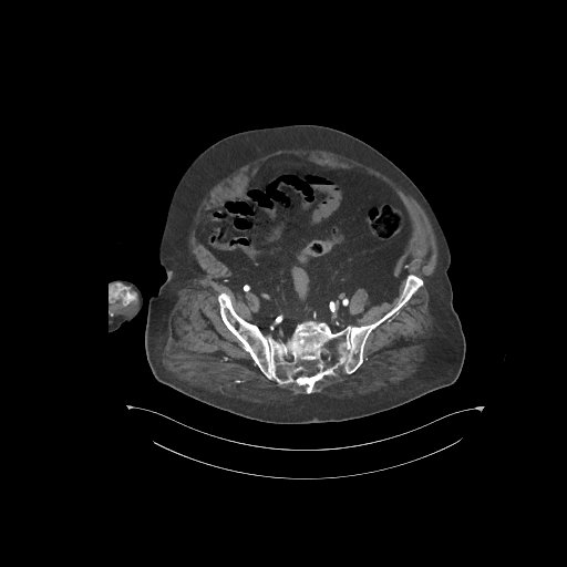 File:Bowel ischemia secondary to SMA occlusion with extensive portomesenteric venous gas (Radiopaedia 54656-60871 A 9).jpg
