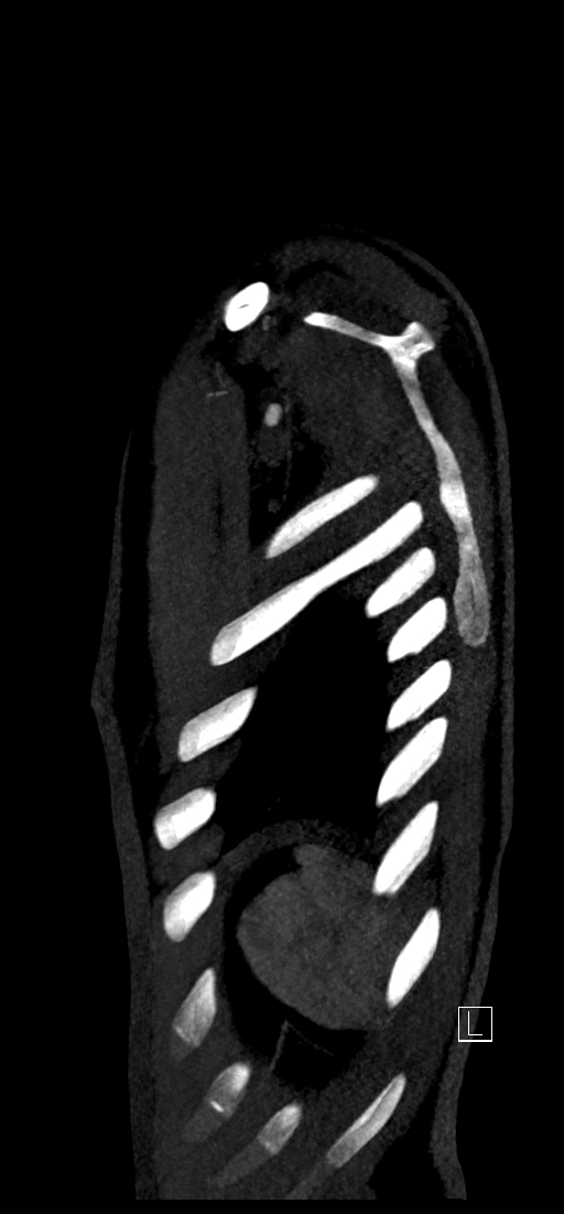 Brachiocephalic trunk pseudoaneurysm (Radiopaedia 70978-81191 C 86).jpg