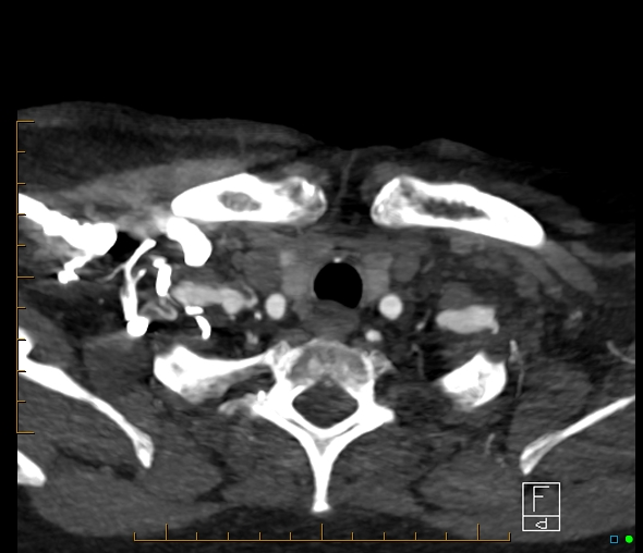 File:Brachiocephalic trunk stenosis (Radiopaedia 87242-103519 A 122).jpg