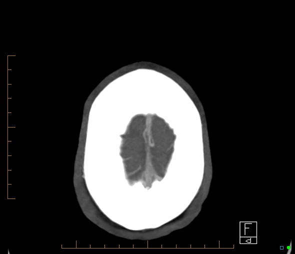 File:Brachiocephalic trunk stenosis (Radiopaedia 87242-103519 A 3).jpg