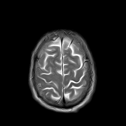 File:Brain abscess complicated by intraventricular rupture and ventriculitis (Radiopaedia 82434-96571 Axial T2 22).jpg