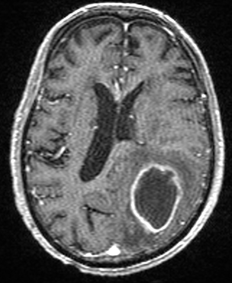 Brain abscess with dual rim sign (Radiopaedia 87566-103938 Axial T1 C+ 100).jpg