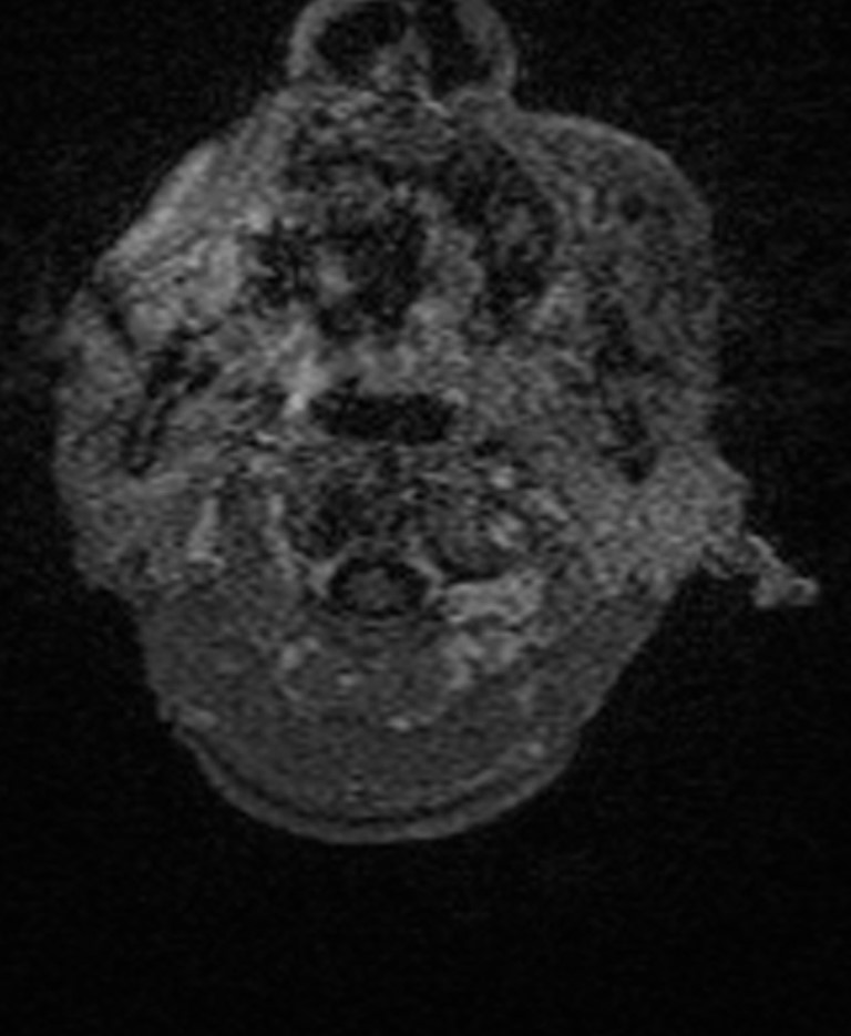Brain abscess with dual rim sign (Radiopaedia 87566-103938 Axial T1 C+ 5).jpg