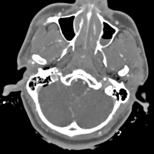 File:Brain contusions, internal carotid artery dissection and base of skull fracture (Radiopaedia 34089-35339 D 46).png