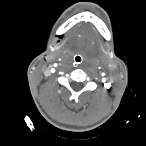 File:Brain contusions, internal carotid artery dissection and base of skull fracture (Radiopaedia 34089-35339 D 69).png