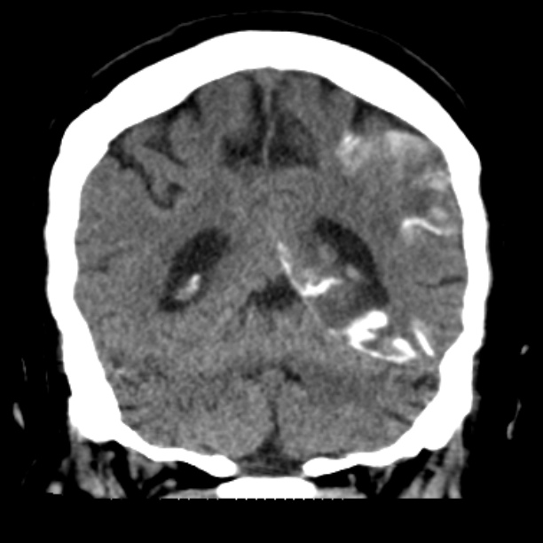 Brain cortical laminar necrosis (Radiopaedia 25822-25971 C 39).jpg