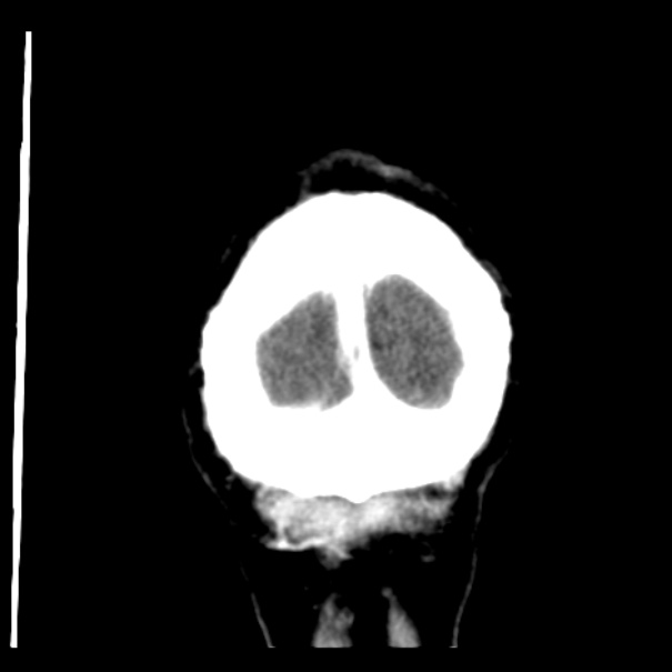 Brain metastases from lung cancer (Radiopaedia 24480-24781 Coronal C+ delayed 60).jpg
