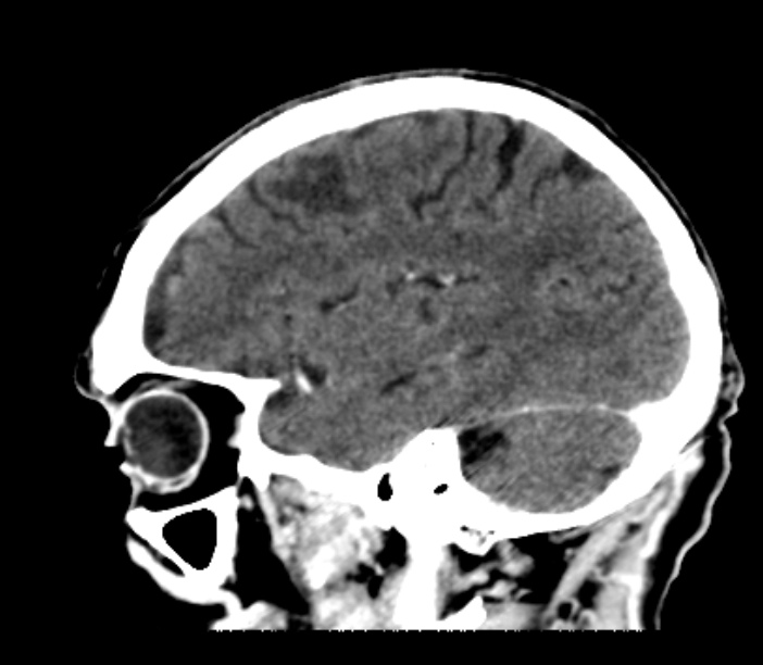 Brain metastases from lung cancer (Radiopaedia 27849-28092 Sagittal C+ delayed 45).jpg