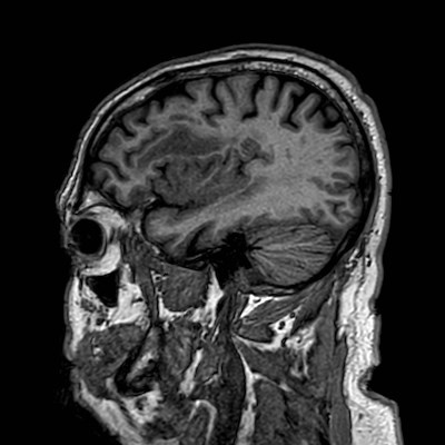 Brain metastases from lung cancer (Radiopaedia 83839-99028 Sagittal T1 29).jpg