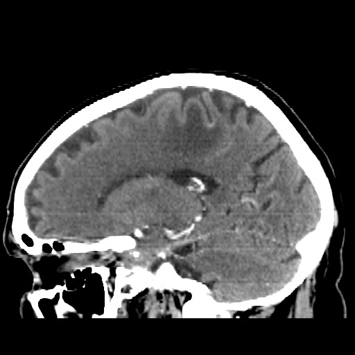 Brain metastasis (Radiopaedia 42617-45760 D 34).jpg